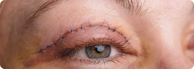 Blefaroplastia em Rio Branco